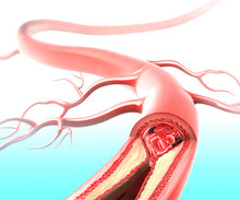 Arterienverkalkung bei Schlaganfall