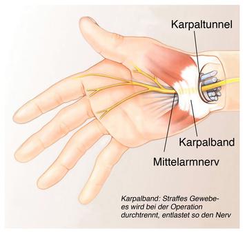 Karpaltunelsyndrom - Anatomie